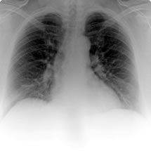 Dušnost a kašel jsou nejčastějšími potížemi při onemocnění plic